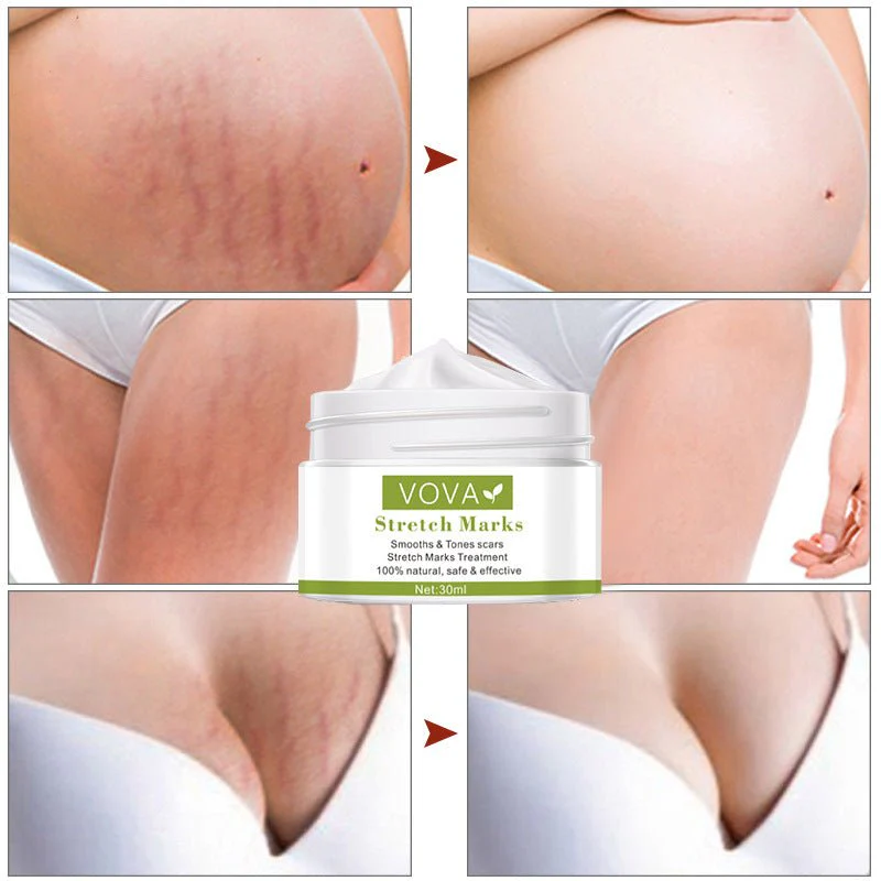 Anti-Stretch Marks Scar Removal Cream - Image 2